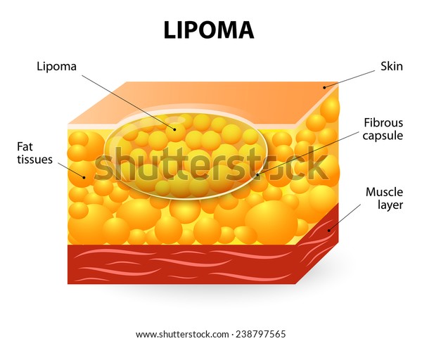 Lipoma Adipose Tumors Located Subcutaneous Tissues Stock Illustration ...