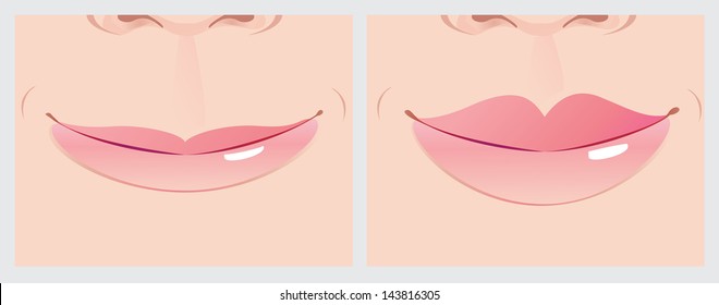 Lips Correction Creating Beautiful Smile Line.