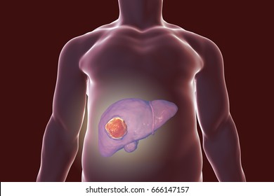 Liver Cancer. 3D Illustration Showing Presence Of Tumor Inside Liver