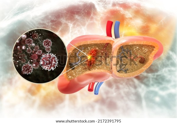 Liver cancer or\
liver tumor, Hepatocellular carcinoma (HCC), causes, symptoms,\
treatments, 3d\
illustration