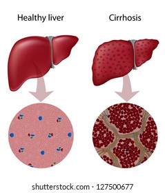 Liver Cirrhosis Disease