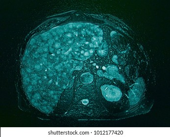 Liver Cirrhosis, Disease, CT Image