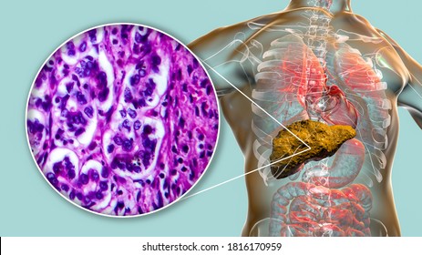 Liver Cirrhosis Inside Human Body 3d Stock Illustration 1815806084