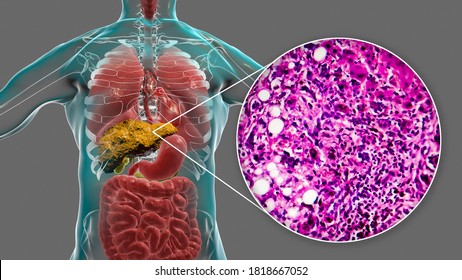 Liver Cirrhosis Inside Human Body 3d Stock Illustration 1824170357 ...