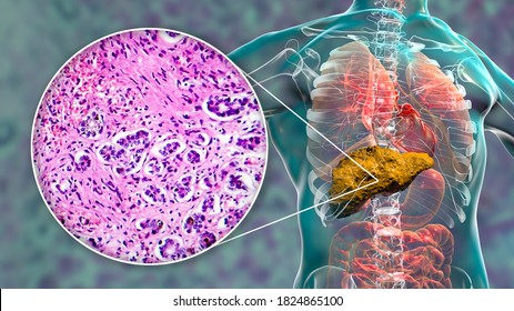 Liver Cirrhosis Inside Human Body 3d Stock Illustration 1824865100 ...