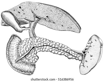 Liver - Cirrhosis. Also Shown Are The Gall Bladder, Pancreas, Spleen, Duet To Intestines.