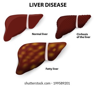 4,640 Unhealthy liver Images, Stock Photos & Vectors | Shutterstock