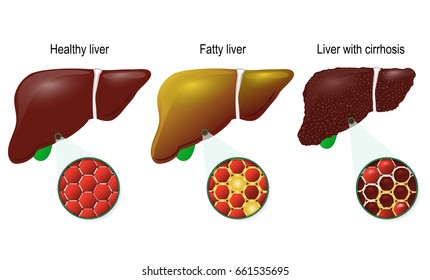 Liver Disease. Healthy, Fatty And Cirrhosis Of The Liver. Liver Cells (hepatocyte). 