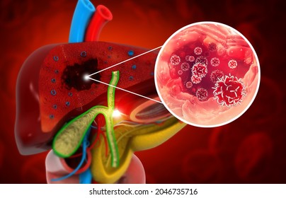 Liver Disease. Liver Infection. Viral Infection. 3d Illustration 