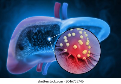 Liver Disease. Liver Infection. Viral Infection. 3d Illustration 