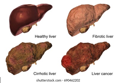 524 Hepatocellular Images, Stock Photos & Vectors | Shutterstock