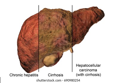 524 Hepatocellular Images, Stock Photos & Vectors | Shutterstock