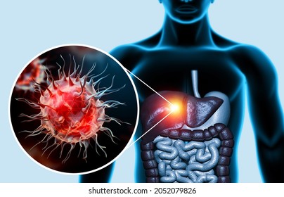 Liver Disease. Viral Infection. 3d Illustration