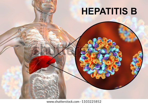 Hígado Con Infección Por Hepatitis B: Ilustración De Stock 1103225852 ...