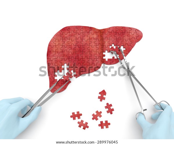 肝脏手术拼图概念 外科医生用手术器械 工具 进行肝脏外科手术作为肝脏疾病 肝硬化 肝癌 肝炎 的结果库存插图
