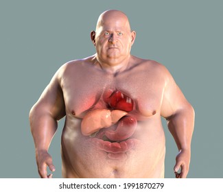 Liver Steatosis In Obese Man, Fatty Liver, 3D Illustration. Concept Of Obesity And Inner Organs Diseases, Behavioral Problem, Binge Eating Disorder. Hepatic Steatosis And Steatohepatitis