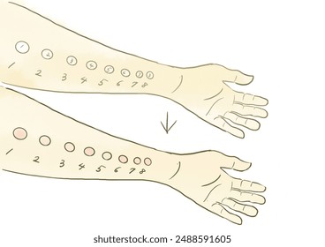 llustration with allergy patch test.