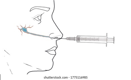 Local anesthetic nerve block with injection
