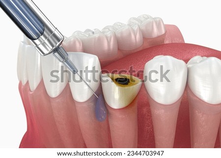 Local Dental anesthesia near damaged tooth. 3D illustration of dental treatment Imagine de stoc © 