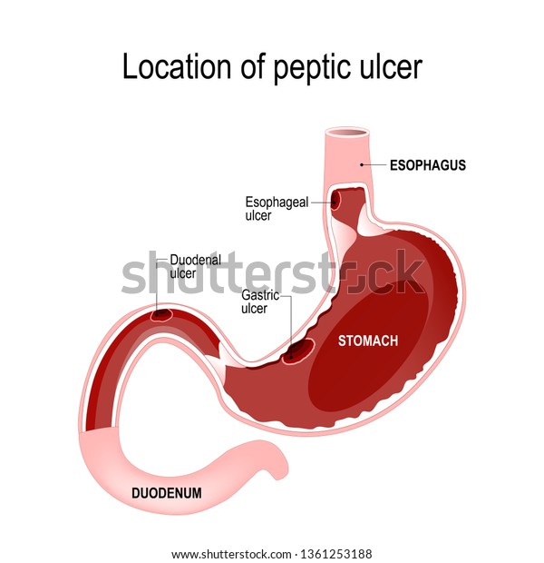 消化性潰瘍の場所 ヒトの消化器系 食道十二指腸胃 人間の胃の断面 医学 生物学 教育 科学の用途に関するイラスト のイラスト素材
