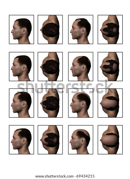 Losing Hair Hair Loss Balding Receding Stock Illustration 69434215