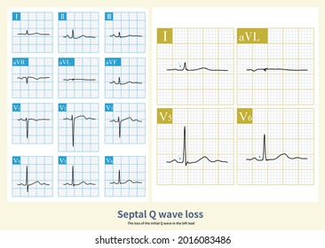 The Loss Of The Initial Q Wave In The Left Lead Of ECG Suggests That The Change Of The Initial Depolarization Direction Of Left Ventricular May Be Physiological Variation Or Septal Myocardial Fibrosis