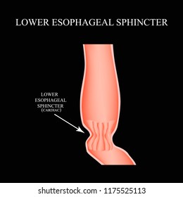 Lower Cardiac Esophageal Sphincter. Infographics. Illustration On Black Background