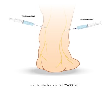 Lower Extremity Nerve Block -Ankle Bkack View. Regional Anesthesia Ilustration. Needle Placement. 