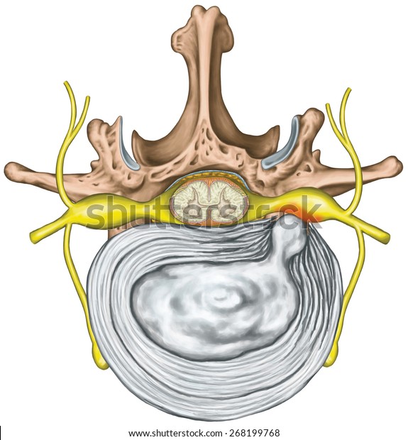 Lumbar Disk Herniation Herniated Disc Lumbar Stock Illustration 268199768