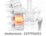 Lumbar intervertebral spine hernia. 3d illustration