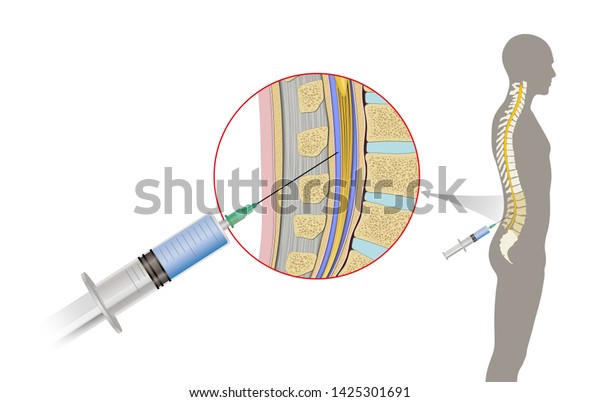 Lumbar Puncture Known Spinal Tap Medical Stock Illustration 1425301691