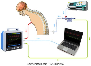 Lumbar Puncture Spinal Tap Canal Diagnostic Collect Sample Patient Treat MS Tumor, 3D Rendering And 2d Graphic