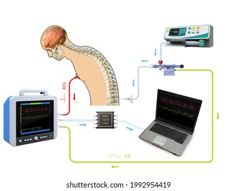 Lumbar Puncture Spinal Tap Procedure Medical Stock Illustration ...