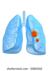 Lung Cancer