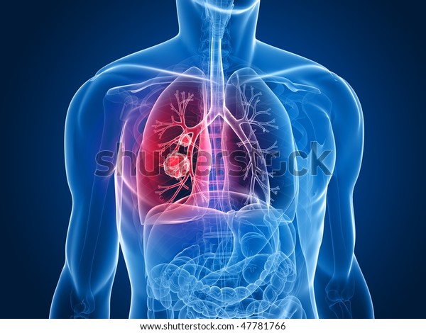 lung\
cancer