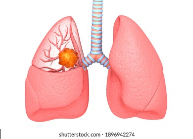 Lung Cancer. Lung Disease. 3d Illustration