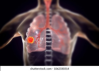 Lung Cancer, Medical Concept, 3D Illustration Showing Cancerous Tumor Inside Human Lung
