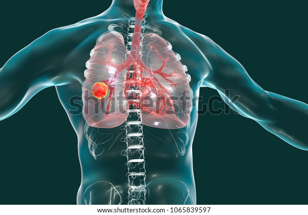 肺がん 医学的コンセプト ヒトの肺内のがん性腫瘍を示す3dイラスト のイラスト素材