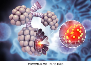 Lung Cancer Tumor Alveoli Respiratory Disease Stock Illustration ...