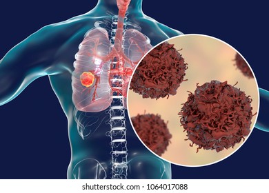 Lung Cancer, Tumor Inside Lung And Close-up View Of Pulmonary Cancer Cells, Illustration