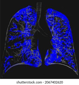 Lung Ct Scan Coronal Plane Radiology Image