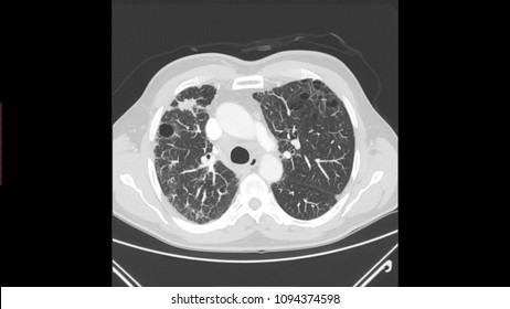 Lung Emphysema In CT Scan