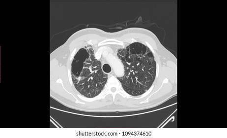 Lung Emphysema In CT Scan