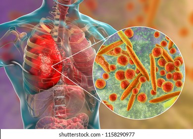 Lung Infection Caused By Bacteria Mycoplasma Pneumoniae, 3D Illustration. Bacterial Pneumonia Medical Concept