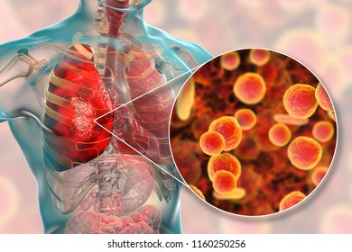 234 Mycoplasma pneumonia Images, Stock Photos & Vectors | Shutterstock