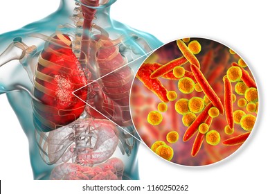 Lung Infection Caused By Bacteria Mycoplasma Pneumoniae, 3D Illustration. Bacterial Pneumonia Medical Concept