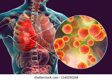 234 Mycoplasma pneumonia Images, Stock Photos & Vectors | Shutterstock