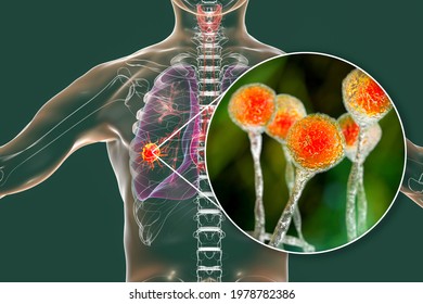 Lung Mucormycosis, A Lung Disease Caused By Fungi Mucor, Also Known As Black Fungus, With Close-up View Of The Fungi, 3D Illustration. Covid-19 Complication