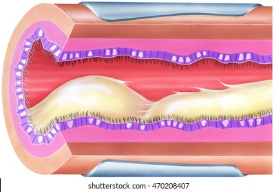 Lungs - Bronchial Mucus Causing Airway Obstruction And Narrowing