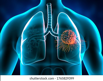 Lungs cancer, tumor in lungs. 3d illustration		